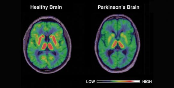Parkinsons Disease Visualizing The Brain